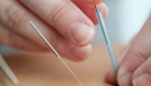 Akupunktur